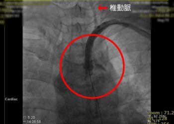 中年女子頭暈多年手愈動頭愈晕   檢查罹患罕見的「鎖骨下動脈竊血症候群」