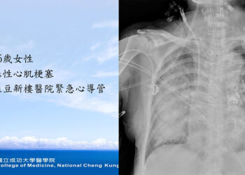 急性心梗併嚴重二尖瓣逆流 經導管助七旬婦重返日常