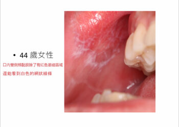 44歲女口腔潰瘍3個月 經檢查竟是扁平苔癬!