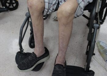 阿嬤常走路跌倒家人以為骨質疏鬆  檢查竟是「肌少症」引起