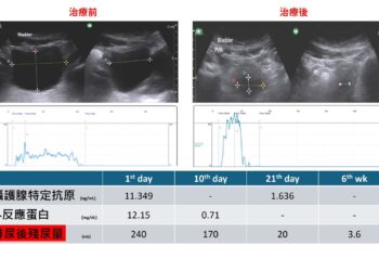 影音/四十多歲男重症肌無力竟「尿」出危機 醫師:排尿藥物使用需慎評 避免誘發呼吸衰竭