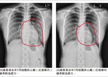廿六歲女子心臟近乎衰竭   健檢發現救回一命