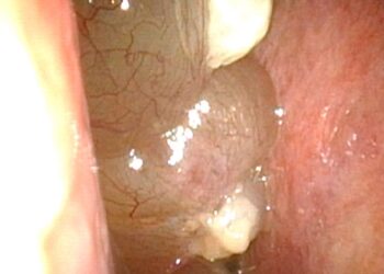 治療慢性鼻竇炎合併鼻息肉 3D立體定位導航手術+生物製劑成新利器