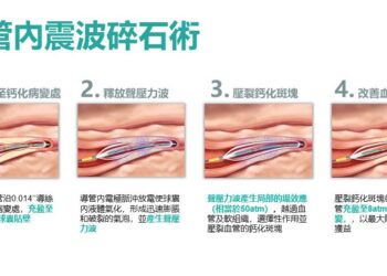 震波碎石心導管術 安泰醫院成功打通鈣化血管救心臟