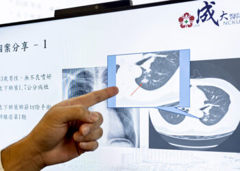 低劑量電腦斷層助早期診斷肺癌 精準治療防治成效高