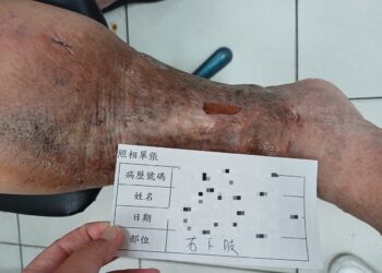 足踝傷口潰爛十多年   求診員榮醫師解決長年困擾