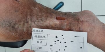 足踝傷口潰爛十多年   求診員榮醫師解決長年困擾