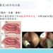 衛福部臺南醫院新進鼻過敏手術式 後鼻神經阻斷術