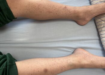 男童皮膚莫名出血點父母誤患血癌？ 檢查是免疫血小板低下紫斑症引起