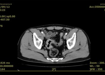 衛生福利部臺南醫院引進雨果機器人輔助微創手術 提供大腸直腸癌及其他手術病人最先進手術治療