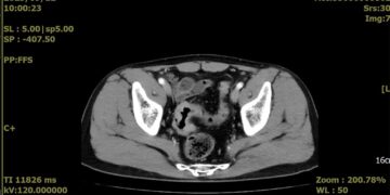 衛生福利部臺南醫院引進雨果機器人輔助微創手術 提供大腸直腸癌及其他手術病人最先進手術治療
