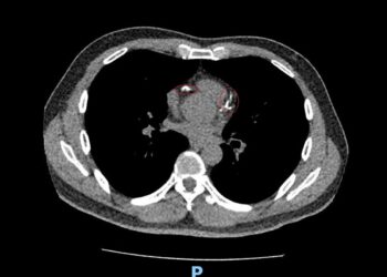 影音/震碎心血管鈣化斑塊  49歲男發願捐108萬