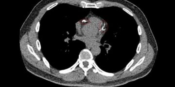 影音/震碎心血管鈣化斑塊 49歲男發願捐108萬