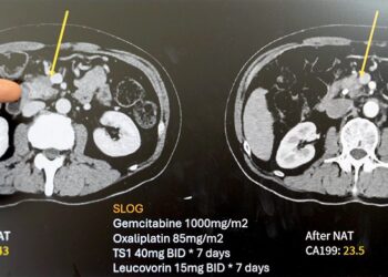 提升存活率的胰臟癌治療新里程　62歲男經【術前化療合併擴大切除】恢復如常