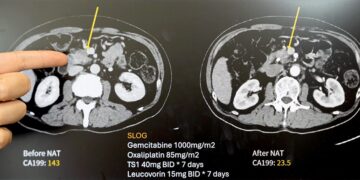 提升存活率的胰臟癌治療新里程　62歲男經【術前化療合併擴大切除】恢復如常