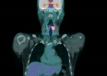 影音/菸檳酒釀惡果　56歲男下咽癌復發「失聲」求生