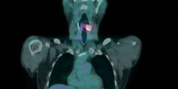 影音/菸檳酒釀惡果 56歲男下咽癌復發「失聲」求生