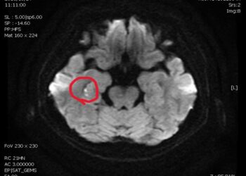 女子反覆問同樣問題事後完全不記得  醫師揪出隱形中風「短暫性全面失憶症」