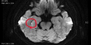 女子反覆問同樣問題事後完全不記得  醫師揪出隱形中風「短暫性全面失憶症」