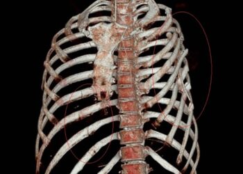 女車禍捲入車底碾壓九死一生 搶回一命卻斷片