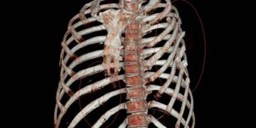 女車禍捲入車底碾壓九死一生  搶回一命卻斷片