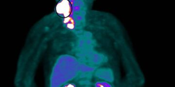 健保也能創造奇蹟 80歲癌末患者放射治療逆轉困境