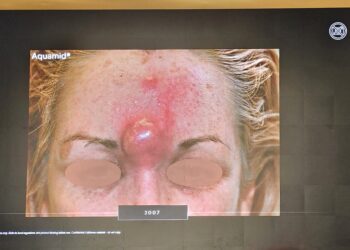 IMCAS發布多起玻尿酸遲發腫塊案例　王正坤醫師示警醫美副作用不可輕忽